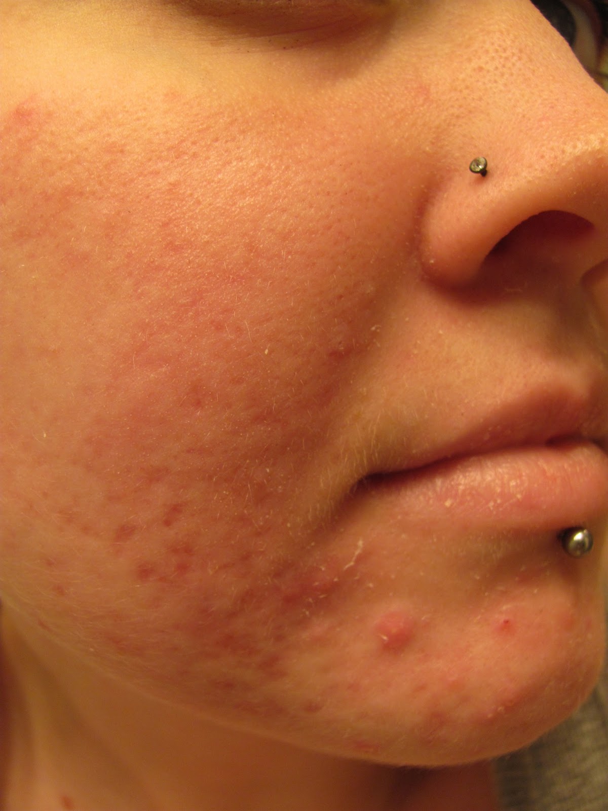 Isotretinoin precio Isotretinoin precio